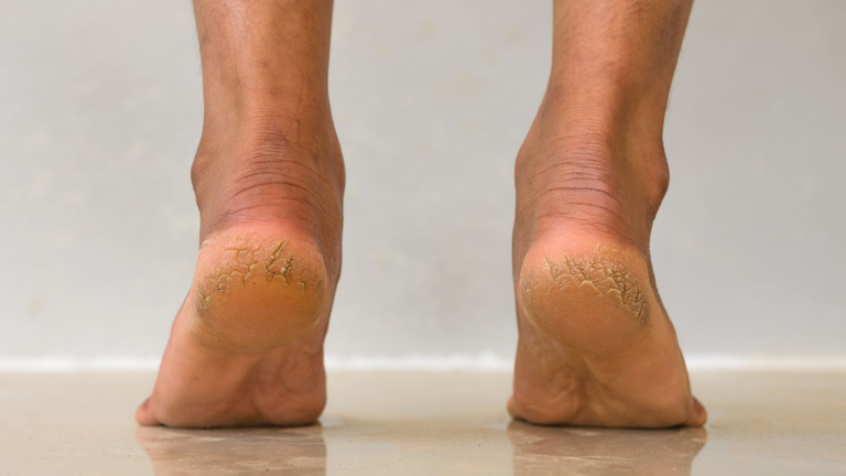 ಬಿರುಕು ಬಿಟ್ಟ ಹಿಮ್ಮಡಿ